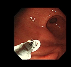 胃アニサキス症の治療