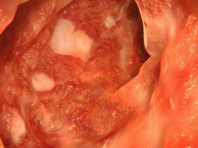 潰瘍性大腸炎